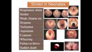 flexible laryngoscopy in congenital stridor [upl. by Jilli390]