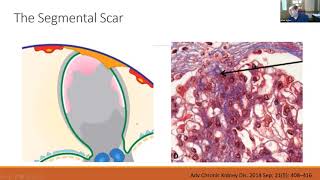 Focal Segmental Glomerulosclerosis FSGS [upl. by Reinhard]