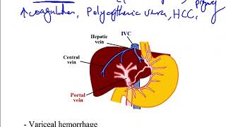 USMLE ACE Video 163 Oncotic and Hydrostatic Pressures Liver Cirrhosis and BuddChiari Syndrome [upl. by Arikaahs]