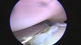 Elbow arthroscopy in a dog with FCP and Incongruency [upl. by Oam562]