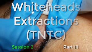 Whiteheads Extraction TNTC  Session 2 Part 3 of 3 [upl. by Avuha]