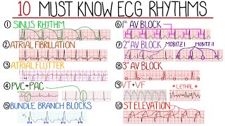 Most Common ECG Patterns You Should Know [upl. by Slyke682]