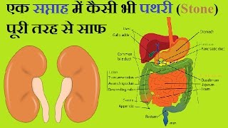 Stone  पथरी  20 MM की पथरी भी एक सप्ताह में चुरा बनकर मूत्रद्वार से बाहर  Home Remedies [upl. by Fernas]