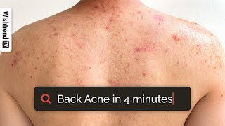 How To Get Rid Of Back Acne  What Habits Cause Bacne Tips amp Products ✨ [upl. by Fuld]