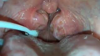 How to remove caseum from your tonsils [upl. by Ahsiam225]