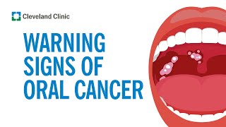 How to Screen Yourself for Oral Cancer [upl. by Hagile]