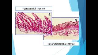 CHV08 Celiakie fenylketonurie diabetes mellitus [upl. by Quitt845]