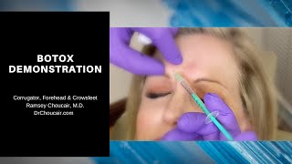 Botox® Demonstration Corrugators Forehead amp Crowsfeet  Ramsey Choucair MD  Ph 2143899797 [upl. by Gaeta337]