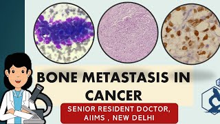 Bone metastasis in cancer Symptoms and diagnosis  A casebased study [upl. by Clyve541]