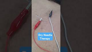 Dry Needle TherapyDry Needling Therapy For Shoulder PainNeedle TherapyNerve StimulationDrAnup [upl. by Peedsaj]