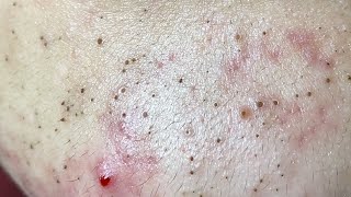 Acne Treatment Huong Da Nang The video has been lost for a long time Remove Blackheads [upl. by Emlynne]