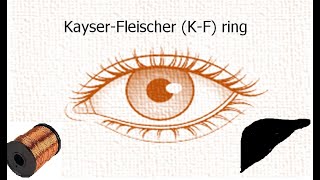 Copper metabolism  Eye Ring  Kayer Fleischer ring I Wilsons disease [upl. by Serle560]