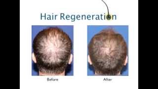 Hair Transplant Alternative  NonSurgical Treatment for Thinning Hair and Stopping Hair Loss [upl. by Sokil]