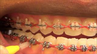 111 HOW TO USE MY INTERDENTAL TOOTHPICKS WITH BRACES ON [upl. by Allicsirp]