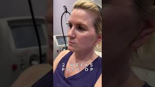 Natural Results  Mini Facelift with Neck Lift  Before amp After [upl. by Tham]