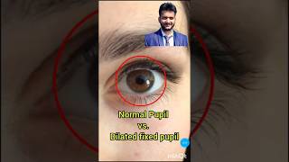 fixed dilated pupil vs normal pupil reaction eye response shorts medical nursing [upl. by Eissej]