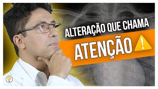 Analisando uma LESÃO PULMONAR CENTRAL com Atelectasia PósObstrutiva no TÓRAX [upl. by Brantley]