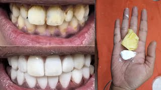 In just Two Minutes White Teeth Whiten And Shiny Like Pearls This Recipe [upl. by Alset]