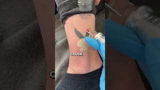 Tattoo Removal hwclinicbrugge [upl. by Allisirp]