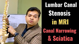 Secondary Canal Stenosis Foraminal Stenosis Stenosis of the Spine in MRI Sciatica MRI PART 2 [upl. by Sardella]