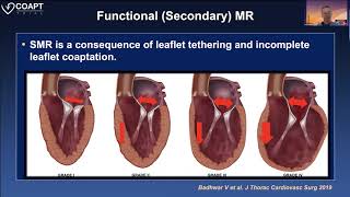 The COAPT Trial The Latest Data and Next Steps in CatheterBased Repair of FMR [upl. by Maegan]