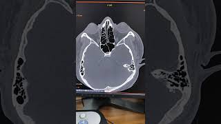 CT SCAN OF PARANASAL SINUSfind the diagnosisctscan mri shorts viralshort anatomy viratkohli [upl. by Leanor]