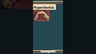 Hyperdontia [upl. by Lihp]