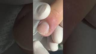 Unhas encravadas 02022024 viral ingrowntoenail infectednail podologoleonardovieira [upl. by Fedirko]