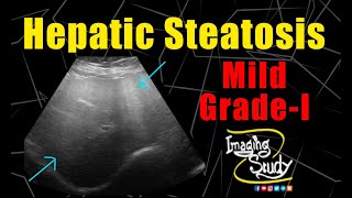 Mild Hepatic Steatosis  GradeI Fatty Liver  Ultrasound  Case 230 [upl. by Mehetabel]