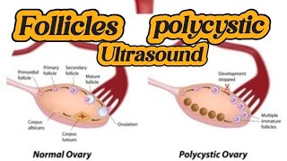 Ultrasound Ovarian Follicles  Adnexal Cyst with Septation  Hemorrhagic Cyst  PCO on Ultrasound [upl. by Eleinad]