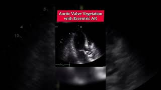 Aortic Valve Vegetation with eccentric AR echocardiography [upl. by Gonzalez]