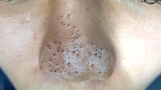 Big Cystic Acne Blackheads Extraction Blackheads amp Milia Whiteheads Removal Pimple Popping  9146 [upl. by Lilla]