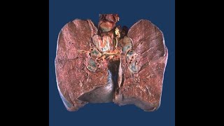 GENERAL PATHOLOGY 28  sarcoidosis DR SAMEH GHAZY [upl. by Woll]