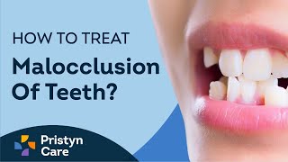 What is Malocclusion of Teeth  How to Treat Malocclusion [upl. by Maurene]