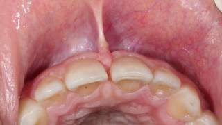 Cavid Ahmedbeyli  Laser Frenectomy [upl. by Mushro664]