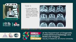 Emergency epistaxis embolization after nasal and oral surgical interventions traumatic epistaxis [upl. by Legra]