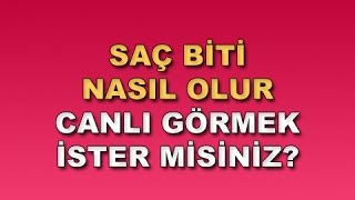 Saç Biti Nasıl Olur  Canlı Görmek İster misiniz [upl. by Audly]