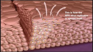 Cervical Cancer Disease Progression and Prevention Screen Manage and Diagnose More Accurately [upl. by Rachael]