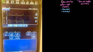 Principle of Mechanical Ventilation 5 Assist Control Volume Control [upl. by Tips]