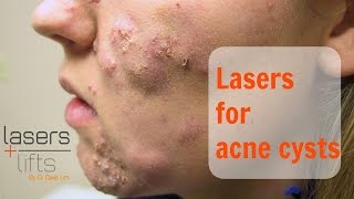 Treating acne cysts [upl. by Xaviera85]