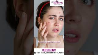 different types of acne skincare glowingskin skin healthyskin [upl. by Edythe]