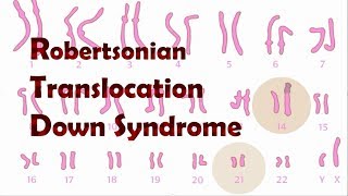 Robertsonian Translocation Down Syndrome ROB [upl. by Sparks]