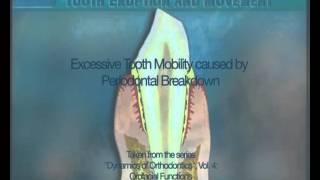 Clip 29 Excessive Tooth Mobility Created by Periodontal Breakdown [upl. by Cullen]