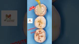 STAMP Technique for Composite direct fillings [upl. by Caton]