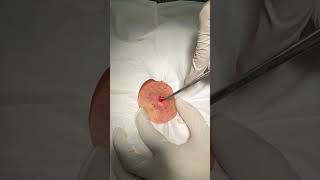 Minimally Invasive Cyst Removal [upl. by Chapland]