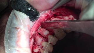 CORTICOTOMY Orthodontic surgery [upl. by Artined335]