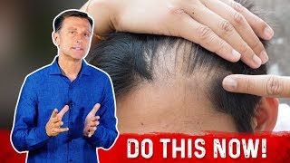 Homemade DHT Blocking Topical Anti Hair Loss Treatment ZIX [upl. by Lydie]