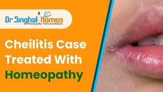 What is Cheilitis  and Homeopathic Treatment for Cheilitis  Dr Singhal Homeo Chandigarh [upl. by Duile]