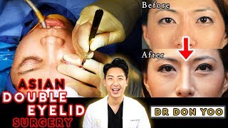 Asian Blepharoplasty  Asian Double Eyelid Surgery  Beverly Hills [upl. by Eiger518]