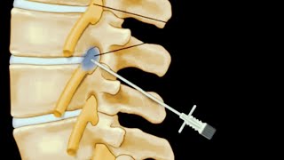 Selective Nerve Root Blocks in Spine Surgery [upl. by Yzeerb270]